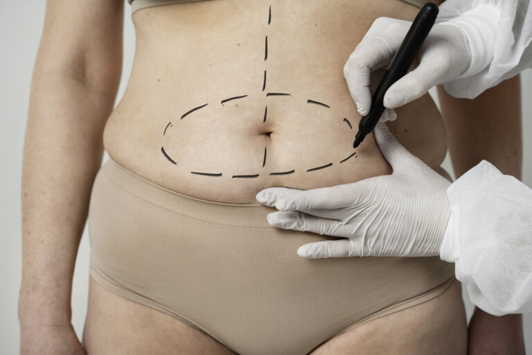 Abdominoplastia